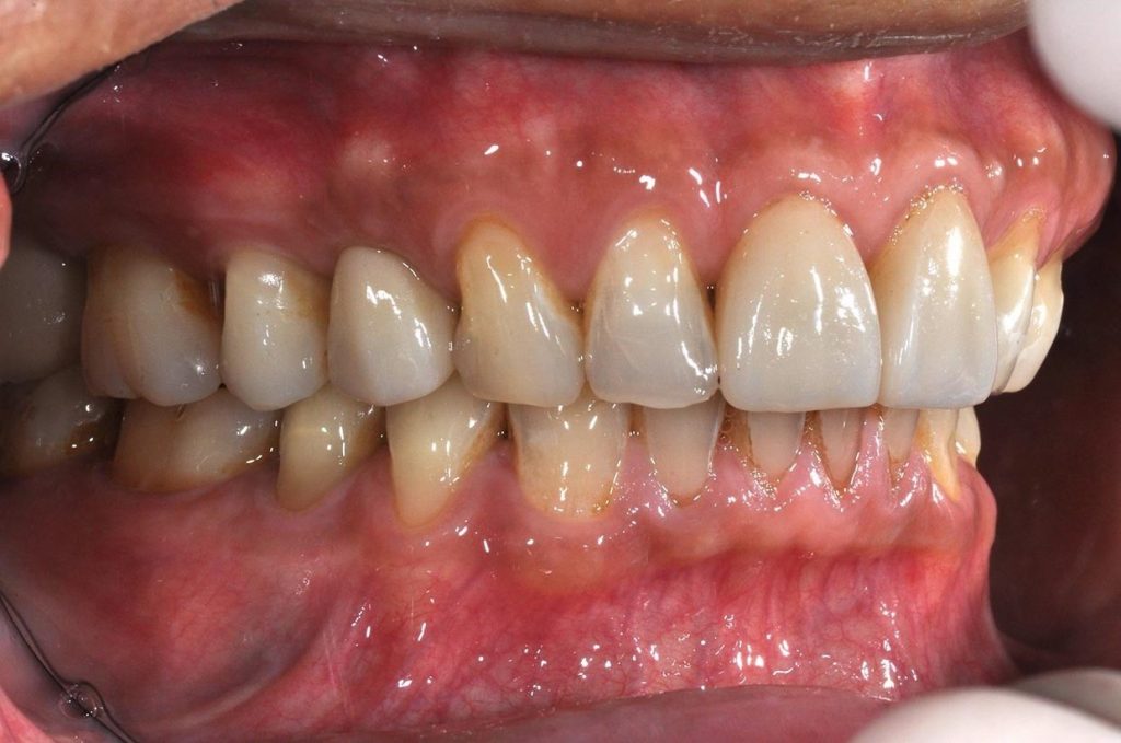 DSC_7344-小臼齒植牙2-全方位牙齒美學權威-張智洋醫師