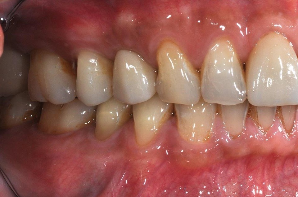 DSC_7344-小臼齒植牙2-全方位牙齒美學權威-張智洋醫師 (2)