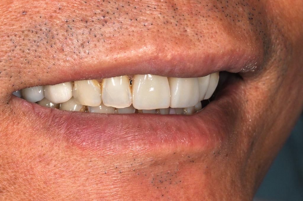 DSC_7579-小臼齒植牙2-全方位牙齒美學權威-張智洋醫師