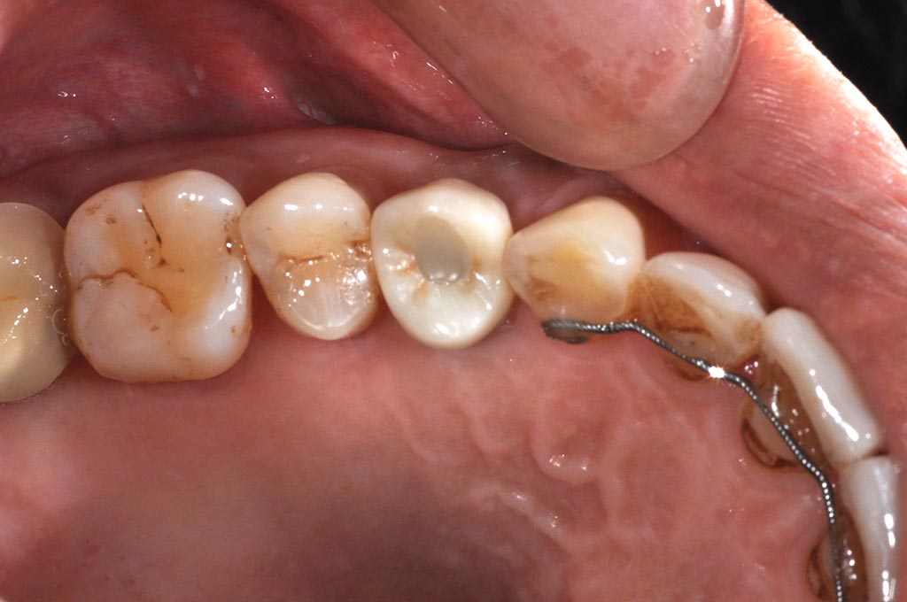 DSC_7587-小臼齒植牙2-全方位牙齒美學權威-張智洋醫師