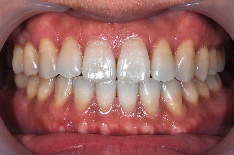 DSC_9395牙齒矯正案例4-全方位牙齒美學權威-張智洋醫師