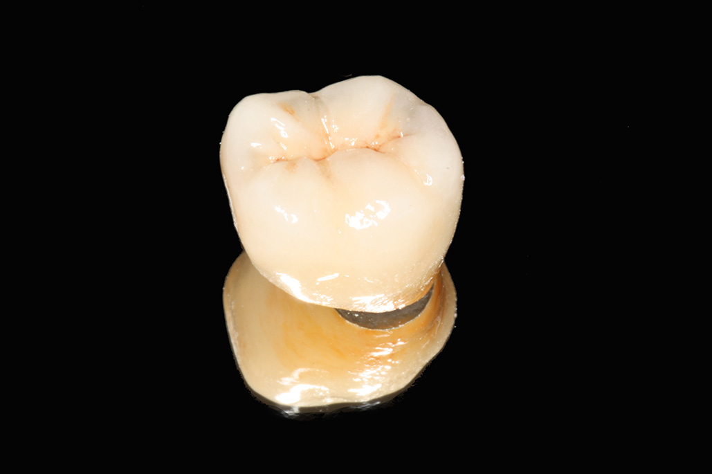 IMG_1622-大臼齒植牙2-全方位牙齒美學權威-張智洋醫師