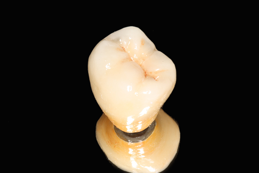 IMG_1627-大臼齒植牙2-全方位牙齒美學權威-張智洋醫師