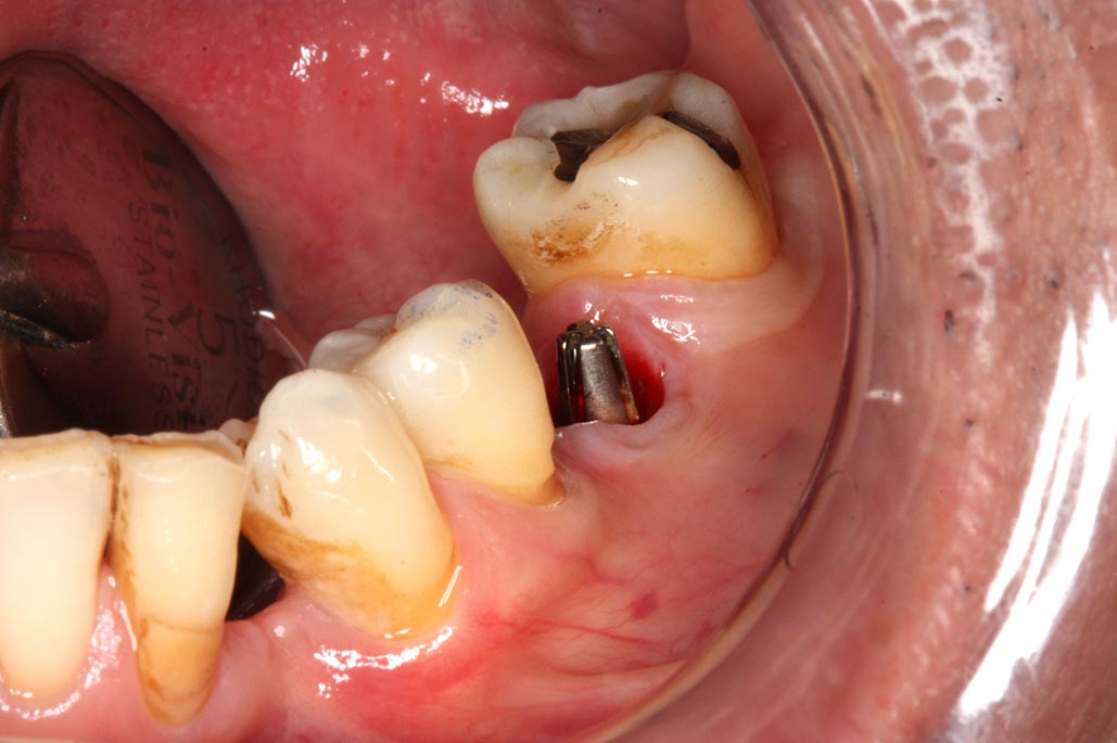 IMG_1638-大臼齒植牙2-全方位牙齒美學權威-張智洋醫師