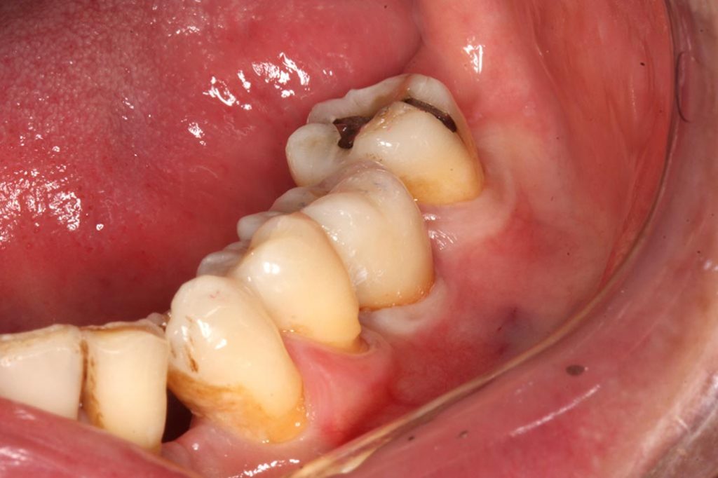 IMG_1640-大臼齒植牙2-全方位牙齒美學權威-張智洋醫師