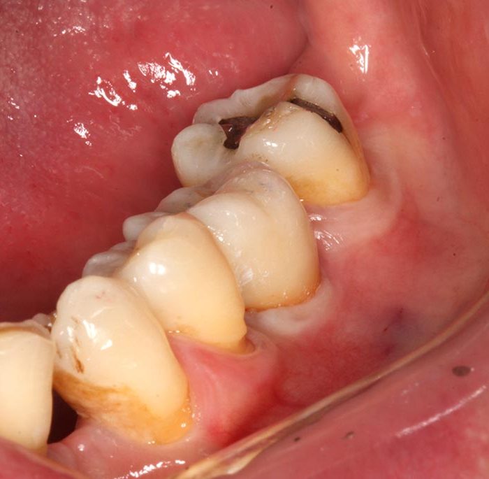 IMG_1640-大臼齒植牙2-全方位牙齒美學權威-張智洋醫師