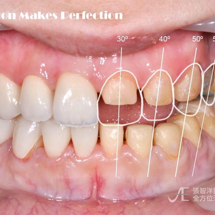 楊full mouth 3-全方位牙齒美學權威-張智洋醫師