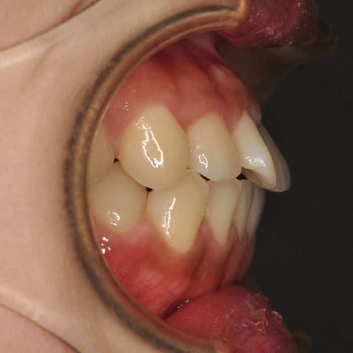 牙齒矯正案例10g 全方位牙齒美學權威 張智洋醫師