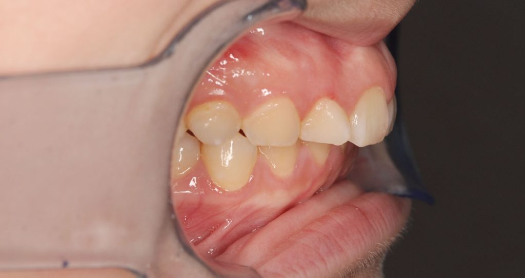 牙齒矯正案例12g 全方位牙齒美學權威 張智洋醫師