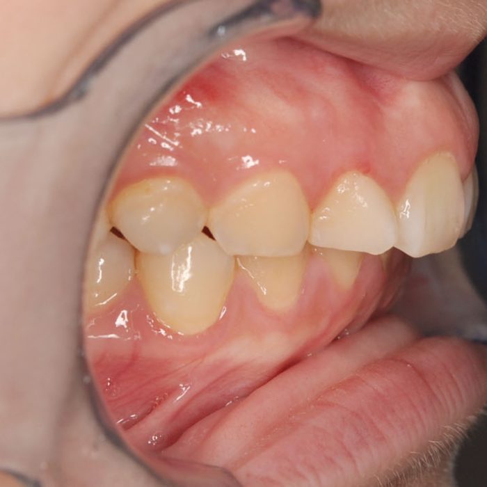 牙齒矯正案例12g 全方位牙齒美學權威 張智洋醫師
