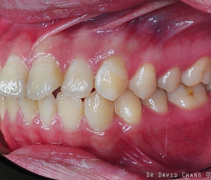 牙齒矯正案例1c 全方位牙齒美學權威 張智洋醫師