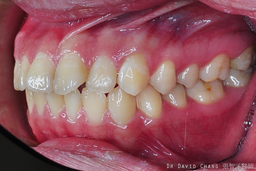 牙齒矯正案例1c 全方位牙齒美學權威 張智洋醫師