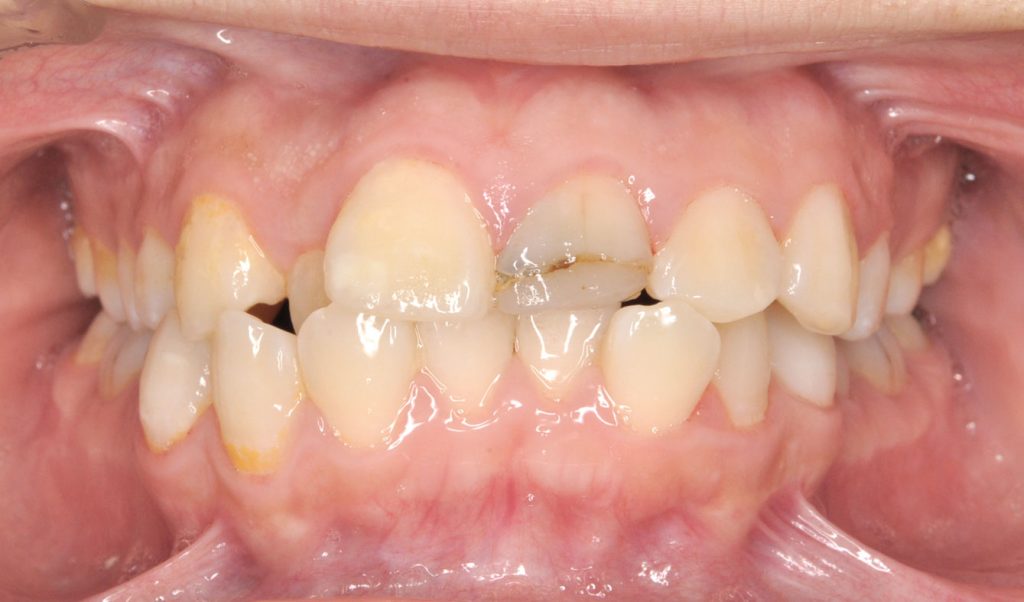 牙齒矯正案例5b 全方位牙齒美學權威 張智洋醫師