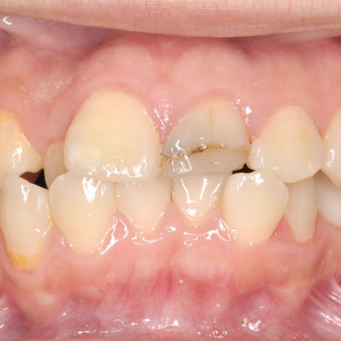 牙齒矯正案例5b 全方位牙齒美學權威 張智洋醫師
