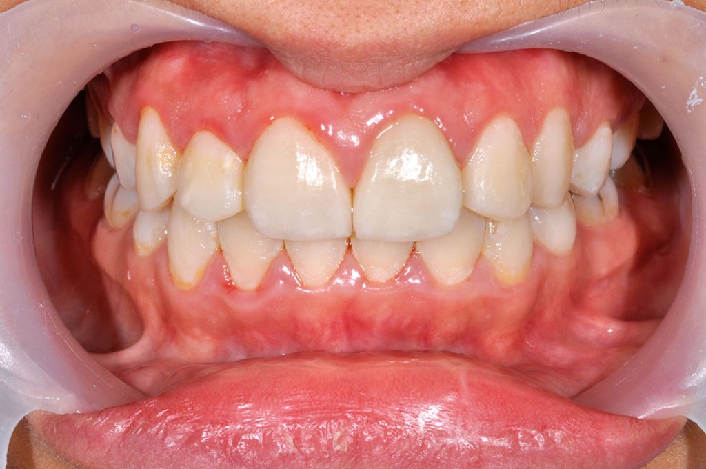 牙齒矯正案例5h 全方位牙齒美學權威 張智洋醫師
