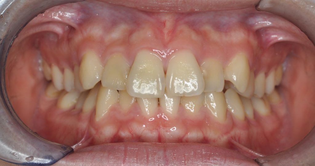 牙齒矯正案例6b 全方位牙齒美學權威 張智洋醫師