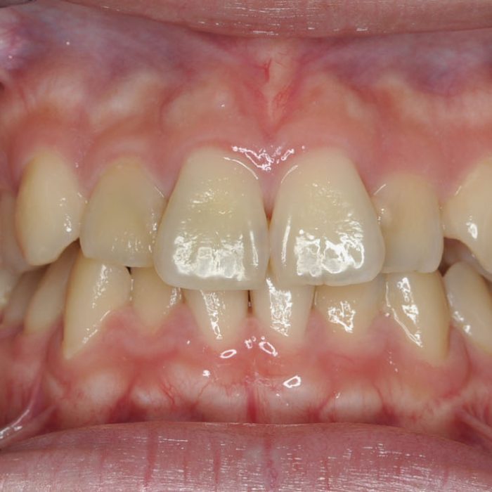牙齒矯正案例6b 全方位牙齒美學權威 張智洋醫師