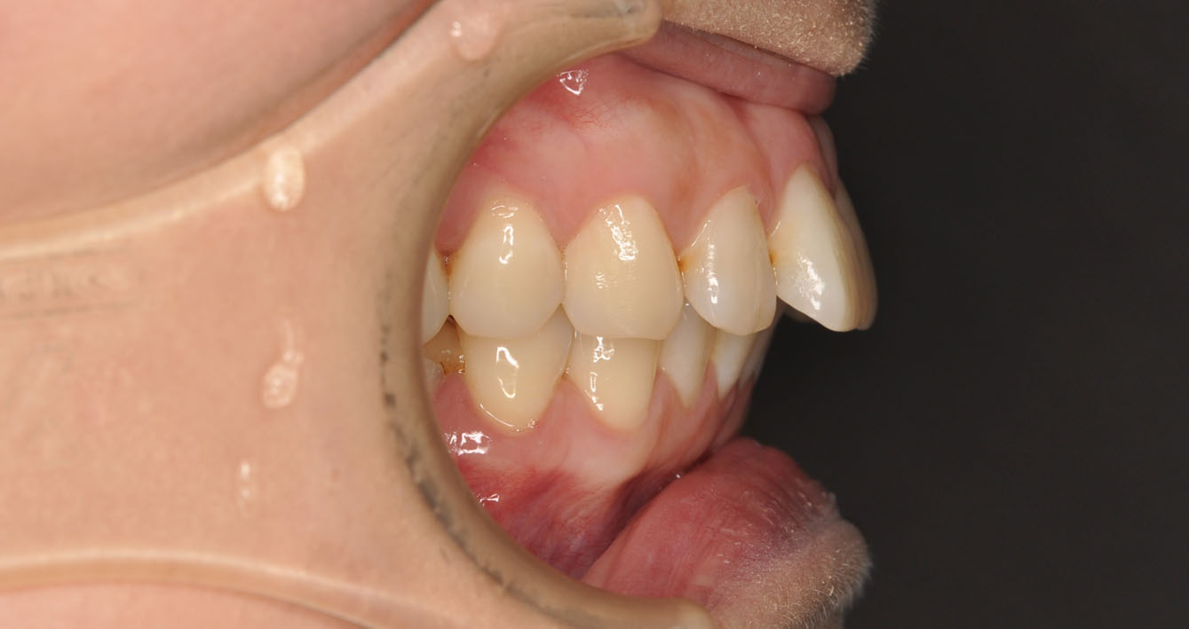 牙齒矯正案例9g 全方位牙齒美學權威 張智洋醫師