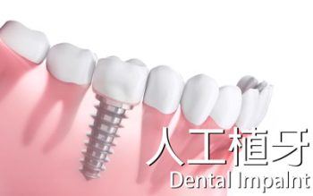 人工植牙 dental-impalnt 案例分享 張智洋醫師