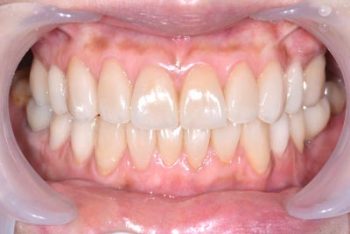 以假牙贋復體修復破損牙齒結構-治療後2---顳顎關節症候群Neuromuscular-small