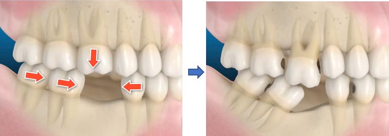 缺牙造成咬合高度喪失4 顳顎關節症候群- 全方位牙齒美學權威 張智洋醫師B