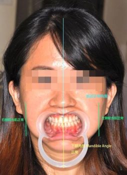 顳顎關節偏移-治療後2---顳顎關節症候群Neuromuscular-Disorder-張智洋醫師-全方位植牙美學權威small