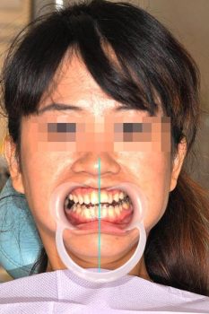 顳顎關節偏移-顳顎關節復位後2---顳顎關節症候群Neuromuscular-Disorder-張智洋醫師small b
