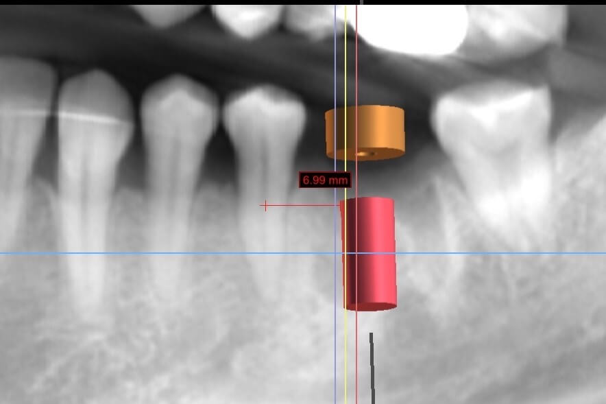 人工植牙e-張智洋醫師 全方位牙齒美學 (1)