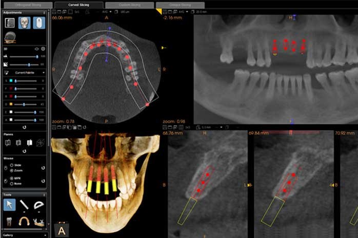 人工植牙g-張智洋醫師 全方位牙齒美學 (2)