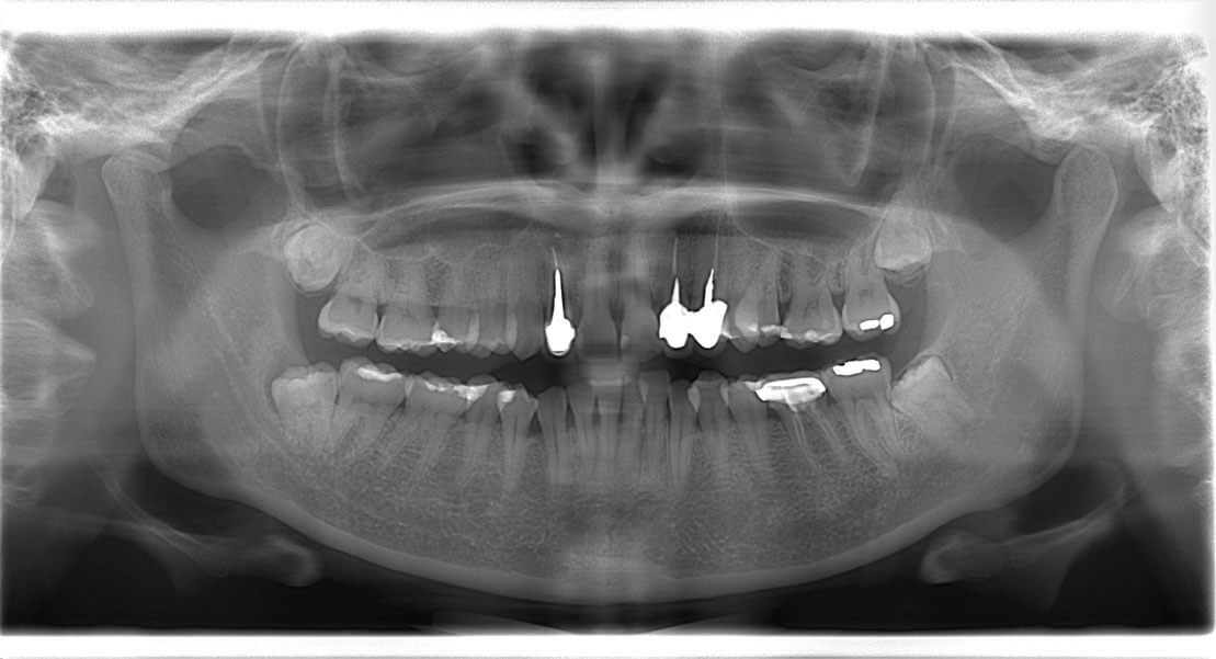 人工植牙h-張智洋醫師 全方位牙齒美學 (2)