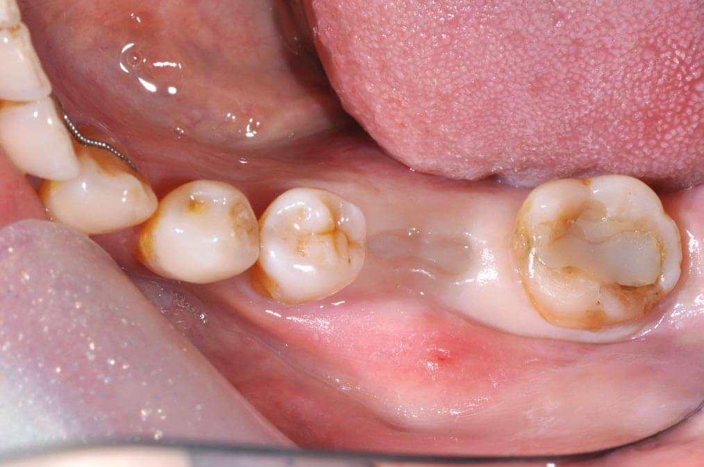 人工植牙m-張智洋醫師 全方位牙齒美學