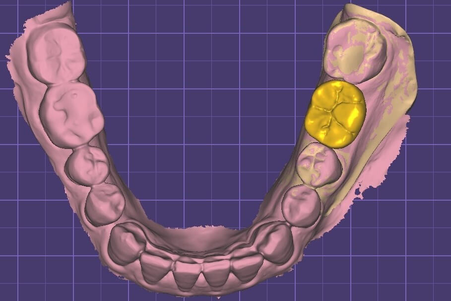 人工植牙p-張智洋醫師 全方位牙齒美學