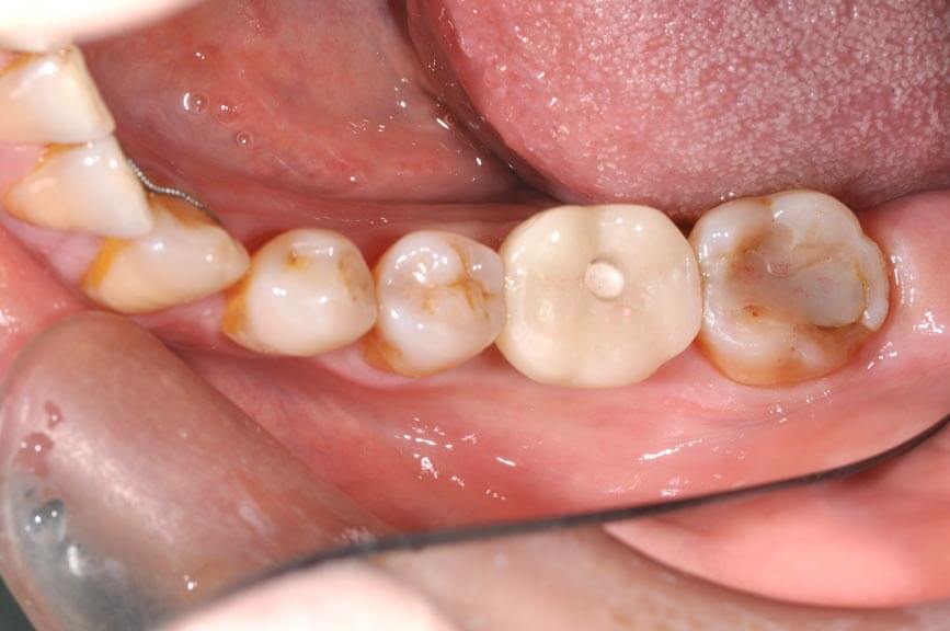 人工植牙t-張智洋醫師 全方位牙齒美學