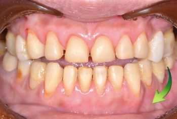 以假牙贋復體修復破損牙齒結構-治療後4bsmall