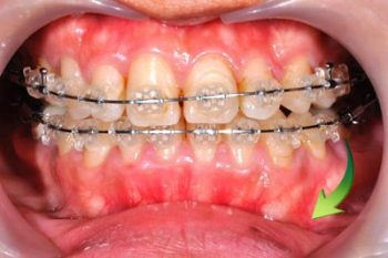復位後的顳顎關節，以矯正治療固定2b---全方位牙齒美學權威-張智洋醫師small