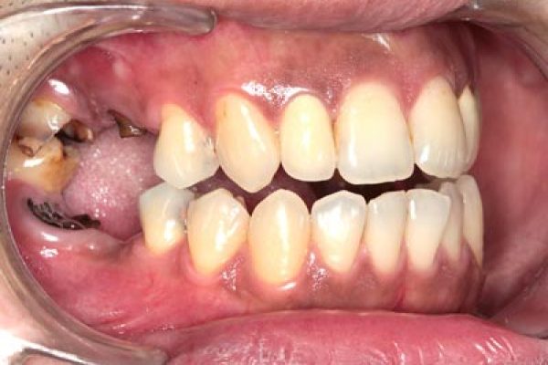 缺牙造成咬合高度喪失1-顳顎關節症候群small-張智洋醫師-全方位植牙美學權威