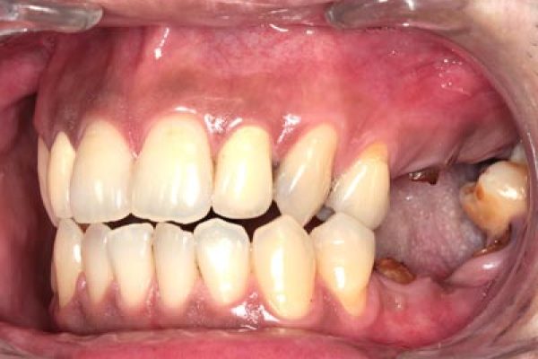 缺牙造成咬合高度喪失2-顳顎關節症候群-張智洋醫師-全方位植牙美學權威small