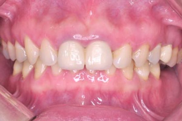 不適當的牙科治療所引起的顳顎關節偏移5-Neuromuscular-Disorder-張智洋醫師-全方位植牙美學權威small