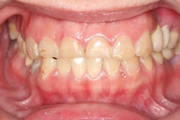 IMG_1026-(2)全口矯正+假牙重建2-Small-張智洋醫師-全方位植牙美學權威