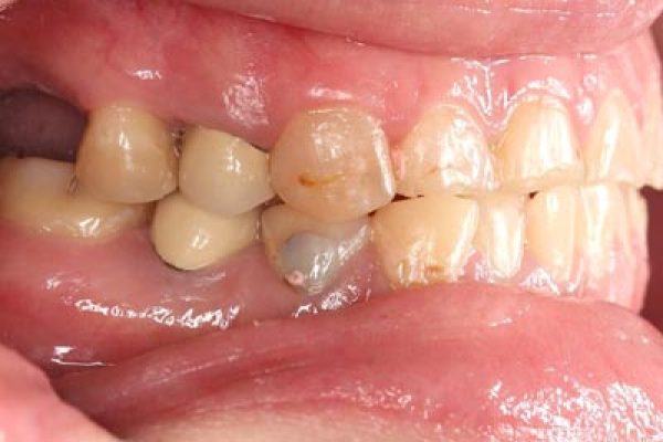 IMG_1034-(2)全口矯正+假牙重建-Small-張智洋醫師-全方位植牙美學權威