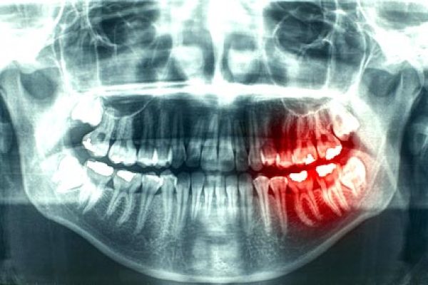 Neuro-Muscular-Dental-xray-牙齒莫名的疼痛 1 顳顎關節偏移症候群 - 全方位牙齒美學權威 張智洋醫師small