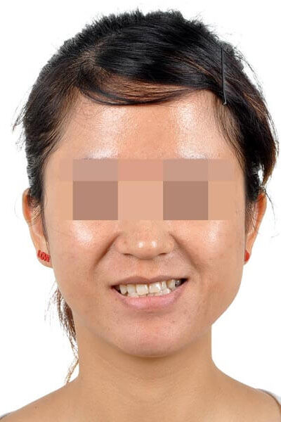 顳顎關節偏移-治療前3---顳顎關節症候群Neuromuscular-Disorder-張智洋醫師small