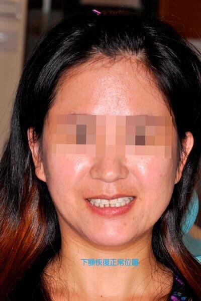 顳顎關節偏移 治療後3 - 全方位牙齒美學權威 張智洋醫師small